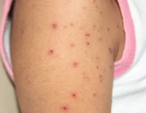 Brote de varicela en la EPET N°1 de Caucete: Salud activó un operativo de vacunación y control